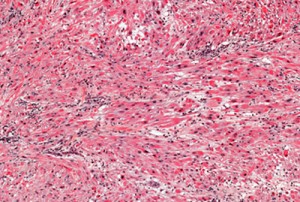 sarcoma-Trabectedin