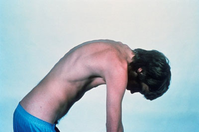 A young man with severe ankylosing spondylitis, showing outward curvature of the spine due to fusion of the vertebrae. CREDIT: Novartis