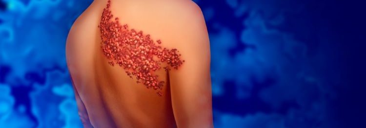 Pfizer and BioNTech mRNA shingles vaccine study begins