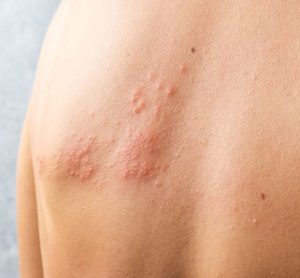Photo of person with shingles rash on skin below left shoulder blade