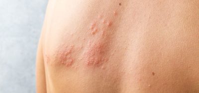 Photo of person with shingles rash on skin below left shoulder blade