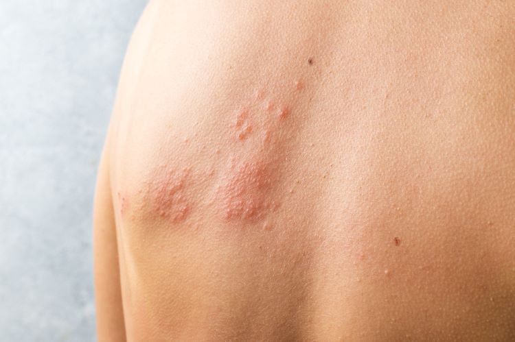 Photo of person with shingles rash on skin below left shoulder blade