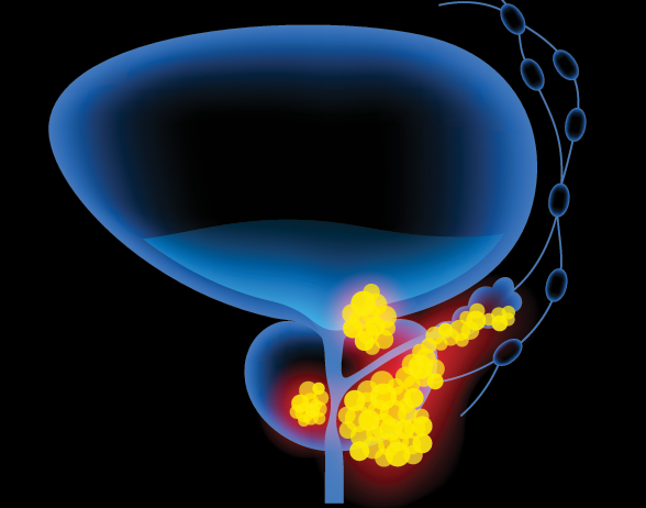 NICE recommends combination therapy for prostate cancer