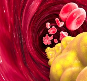 LDL cholesterol in blood stream