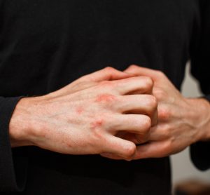 Man with plaque psoriasis scratching hands