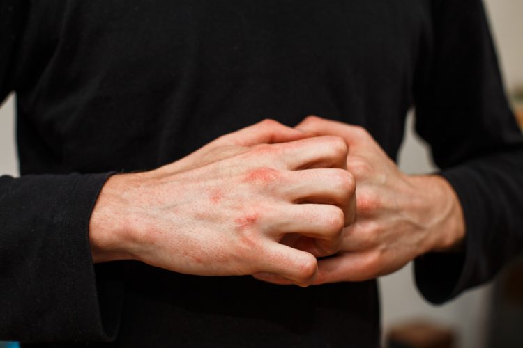 Man with plaque psoriasis scratching hands