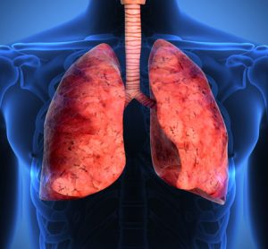 NICE recommends Cinqaero (reslizumab) for treatment of severe asthma