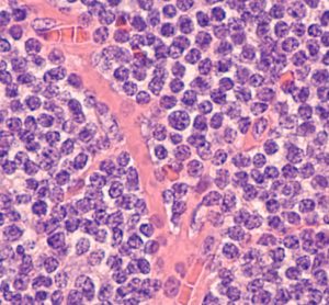 Mantle cell lymphoma sample