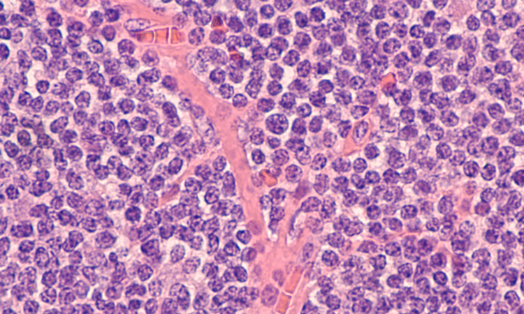 Mantle cell lymphoma sample
