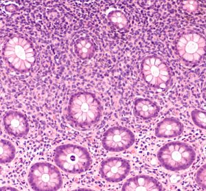 Photomicrograph of diffuse B-cell lymphoma