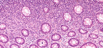 Photomicrograph of diffuse B-cell lymphoma