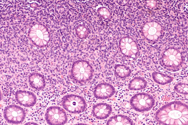 Photomicrograph of diffuse B-cell lymphoma