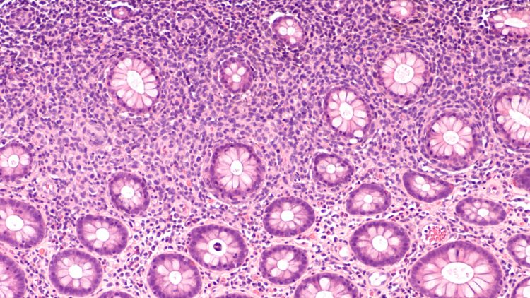 Photomicrograph of diffuse B-cell lymphoma