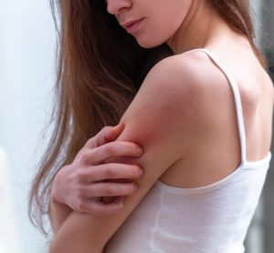 Woman with psoriasis scratching arm