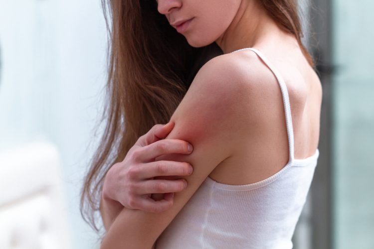 Woman with psoriasis scratching arm