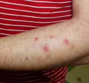 Man with prurigo nodularis on arm