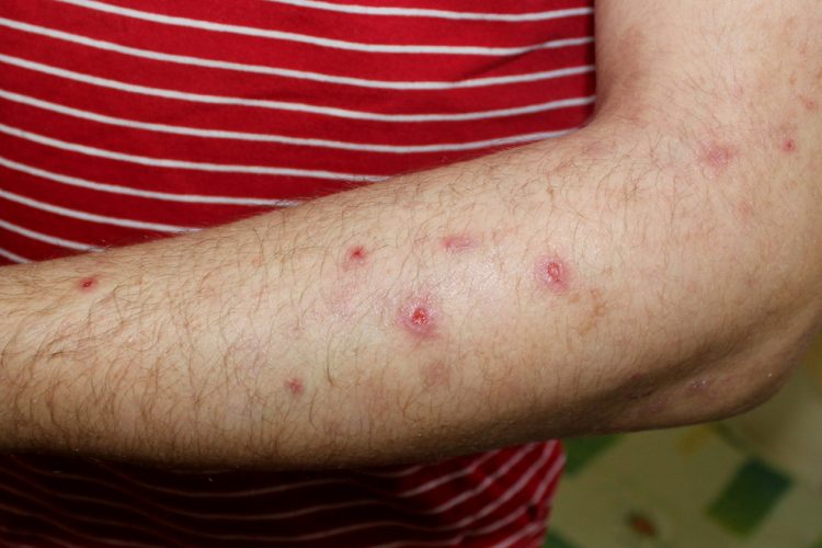 Man with prurigo nodularis on arm