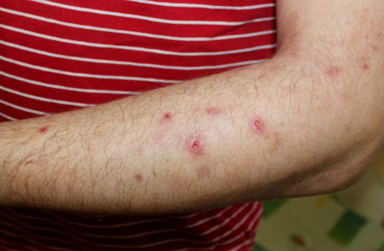 Man with prurigo nodularis on arm