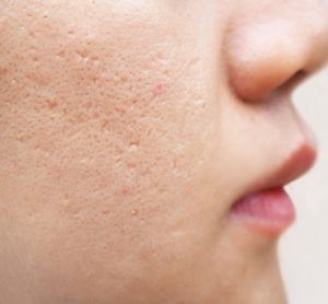 Close-up of woman's face with acne scars