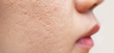 Close-up of woman's face with acne scars