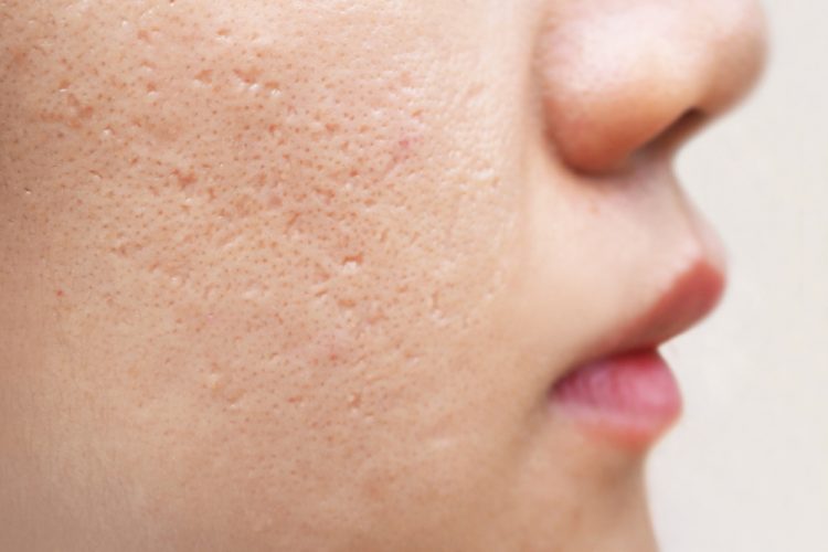 Close-up of woman's face with acne scars