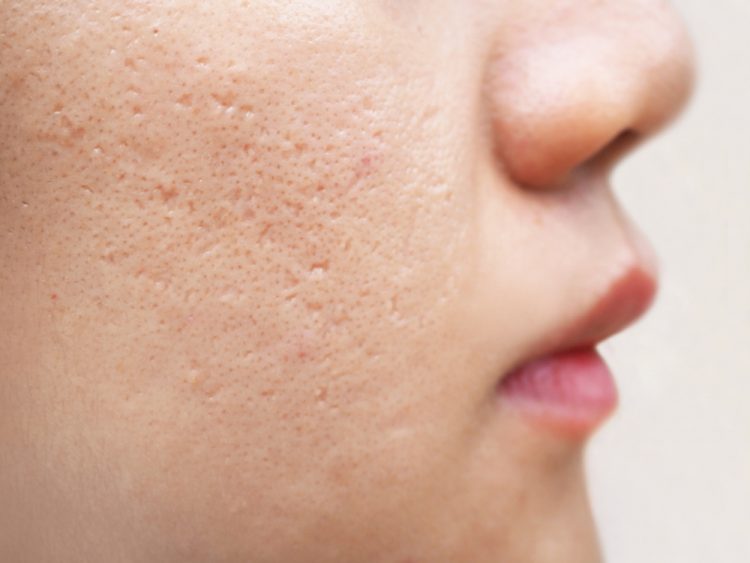 Close-up of woman's face with acne scars