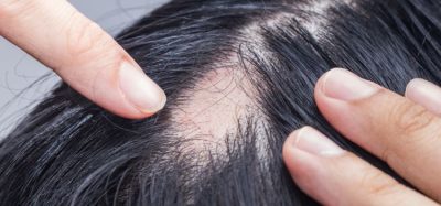 NICE alopecia areata medicine recommendation