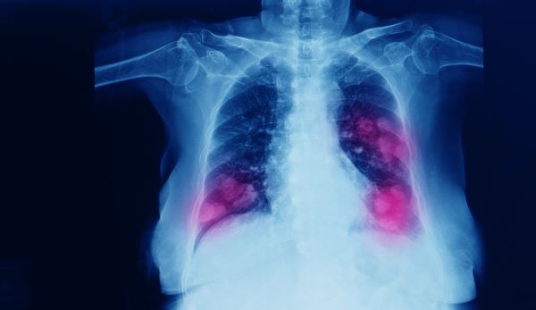 Sanofi stops development of lung cancer drug, tusamitamab ravtansine