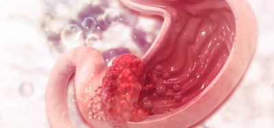 Stomach cancer concept image