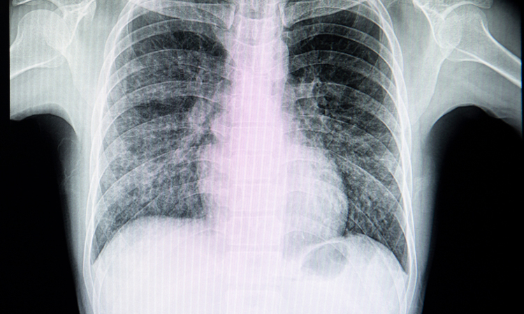 Lungs X-ray