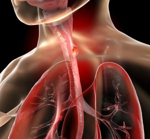 Illustration of esophagus cancer