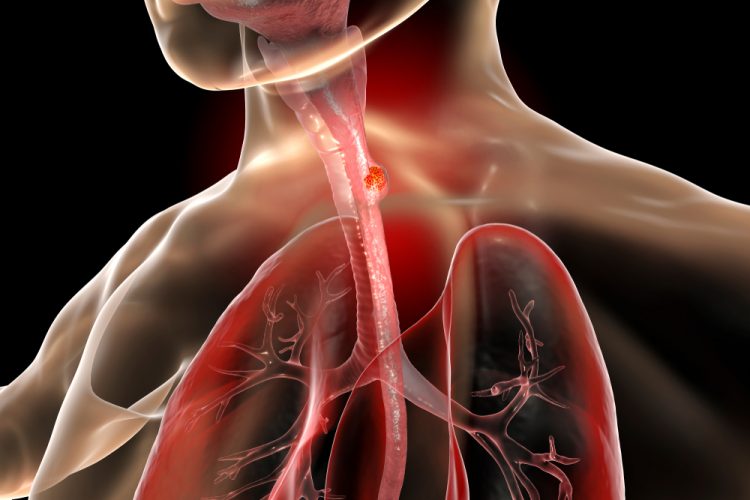 Illustration of esophagus cancer