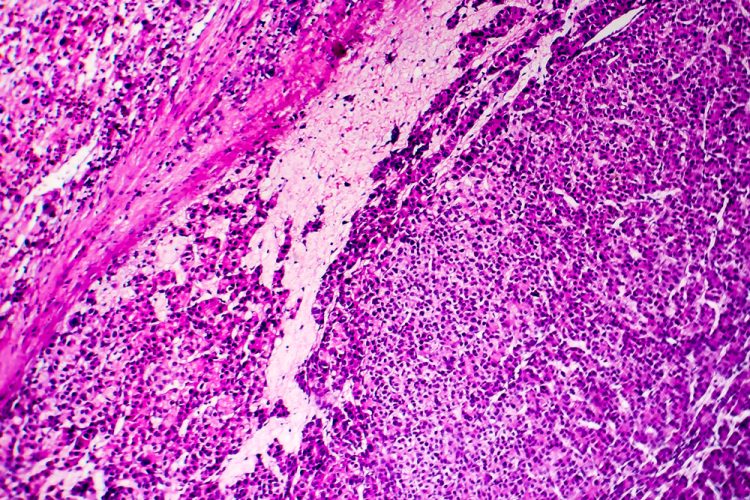 Hepatocellular carcinoma under microscope