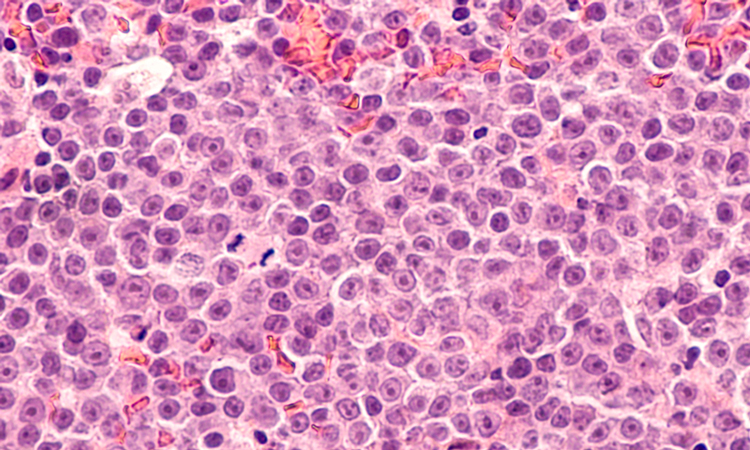 Lymphoma cells