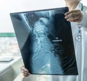 Doctor looking at x-ray of spine with muscular dystrophy (SMA)
