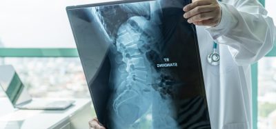 Doctor looking at x-ray of spine with muscular dystrophy (SMA)