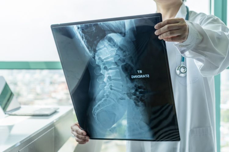 Doctor looking at x-ray of spine with muscular dystrophy (SMA)