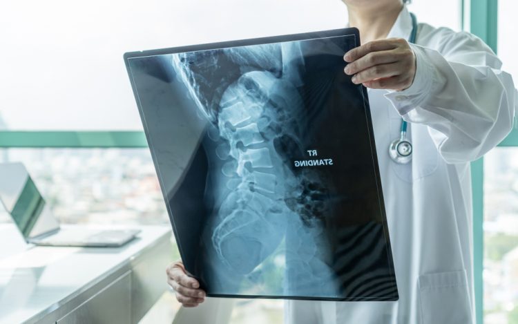 Doctor looking at x-ray of spine with muscular dystrophy (SMA)