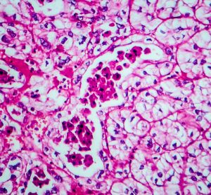 Microscopic view of renal cell carcinoma