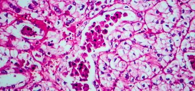 Microscopic view of renal cell carcinoma