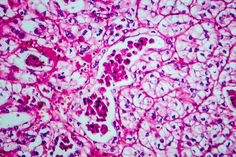 Microscopic view of renal cell carcinoma