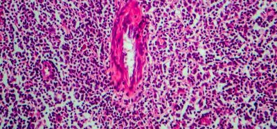 Bristol Myers Squibb Opdivo cHL