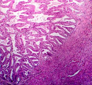 Endometrial adenocarcinoma under the microscope