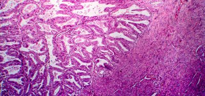 Endometrial adenocarcinoma under the microscope