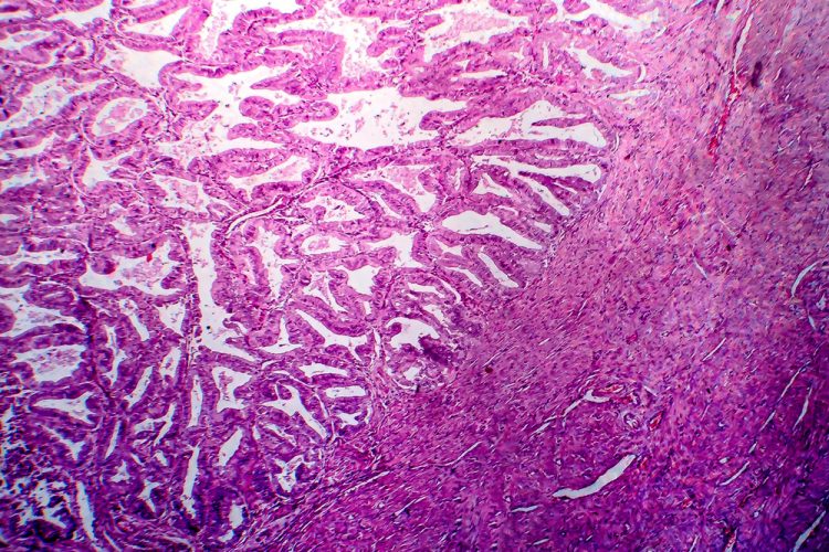 Endometrial adenocarcinoma under the microscope