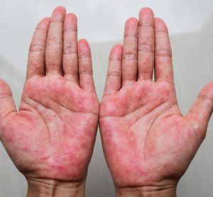 Hands with atopic dermatitis