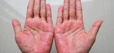 Hands with atopic dermatitis
