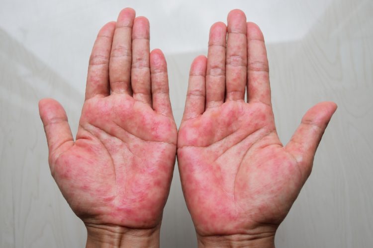 Hands with atopic dermatitis