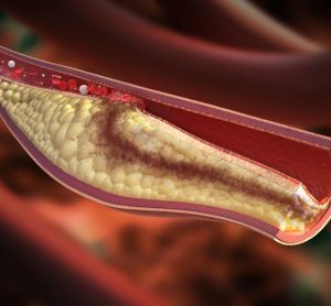 Merck (MSD) Lipoprotein(a) inhibitor atherosclerosis drug
