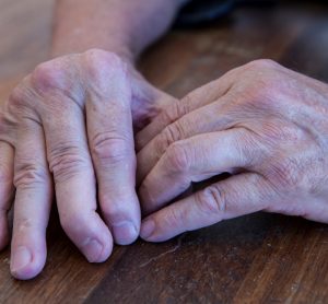 Hands of man with psoriatic arthritis